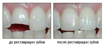 Реставрация зубов Реставрация зубов