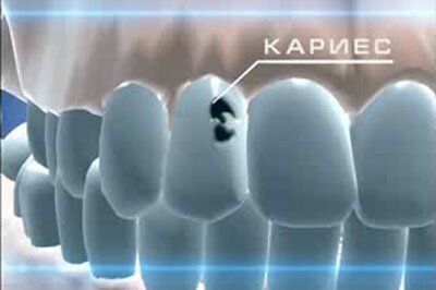 кариес защитит от рака кариес защитит от рака